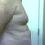 Before - Right Profile (285 lbs)