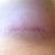 Incision day 20, they both look the same. So happy about how they look. Hopefully in few months I will barely will be able to see them ;-)