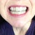 Up close with Invisalign in. After set 4 of 16.
