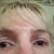 6 weeks after surgery - red marks are gone. No make-up in this picture.