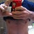 Post Op - Day 4 - First thing in the morning, still not standing up 100% straight but vast improvement.