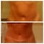 The day of touch up lipo, 2 weeks post op
