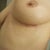 After Surgery- Day 6. Small incisions under my boob.