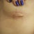 After Surgery- Day 6. Took the tape off today and was surprised at the good work done! These are going to heal so nicely! I don't think there will be much of a scar at all.