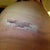 Left side incision