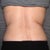 2mos post op
