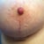 Right scar week 8 with clear scar strip on