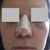 Day 2 after surgery (a.m.)