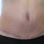 Scar is barely quilted any more at 6 weeks po today.  Belly button is better.