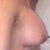 Right side view, DAY 3 Post Op
