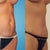 19 days post surgery