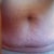 my flap and hernia
