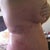 Very bruised and swollen, I was told the skin sagging will slowly get tighter over the next few weeks. But am happy so far with results