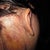 staples at back of neck for neck lift