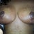 the right breast is still very swollen