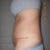 17 days post op left side on