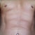 6 weeks post op and went in to see Dr. Lanzer today for a check up. He seemed very pleased with the results, as am I. He recommended 'spectra gel' for my scars which is a very sticky substance that will hopefully help those little round scars heal quickly.