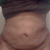 2 days post op! i had alot of lumps the previous day but i got a tighter garment and it has flattened and shaped me of course I still have swelling that is to be expected. I just hope the extra skin at he bottom will bounce back and smooth out as well....The lmps wer horrible but they are gone I will post that pic soon