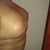 Day 13 Post Op