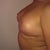 Day 13 Post Op