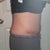2 weeks post op