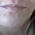 Another view before jaw line