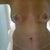TT and breast lift w tapes