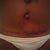 Close up of my incision week 5 it looks good but I have extra skin above my incision on my left below my navel. Dr might have to fix it.