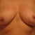 5 months post-op-I think they look pretty good!