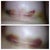 Top is (3/20/13) day of sutures removed. Bottom was yesterday (3/22/13)