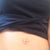 Belly button hernia-need scar revision and hernia repair 