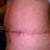 2 months scar