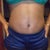 front view up close 13weeks post tt