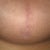 Scar on bottom of breast- barely noticeable (6 months)