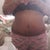 5 WEEKS POST OP SCAR FADING SLOWLY BUT SURLY