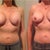 8 - 10 Weeks Post-Op