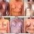 1 - 6 Weeks Post-Op