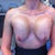 3 Days Post-Op