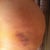 a bruise on my hip