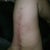 one arm one month after surgery 2 weeks after stitches came out...so far 6.25 inches are gone!