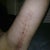 one month out, 2 weeks after stitches out, still swollen and so far ~6.25 inches are gone