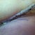 Six days post-op, left side.