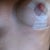 close up of right breast, the one that needed more lift and more 'work' (17 days after surgery)