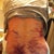 Day 2 PO. This is my lower back area - you can see all the bruising from the lipo on my lower back and on my flanks.