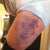 Day 2 PO. My left thigh - I had lipo done there, too.