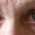 eyes after surgery,cropped.jpg