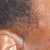 June 22, Two Days Post-Op, Sutures