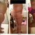 Yay! Swelling is still going down so I'm slowly getting flatter. This is my before, day 4 po, and day 9 po side views. In this photo I still have a lot of pads covering the drain hole on my lower abdomen (in my underwear!). That's why there is such a large pooch in the front of my undies - it's about 3 inches worth of padding, not swelling.