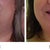 Front view of chin before lipo and 5 days po.