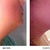 Side view of chin before lipo and 5 days po. Sorry, this one is kind if fuzzy. The difference isn't as pronounced on the side view as it is on the front, but I'm also still swollen so it should go down more.
